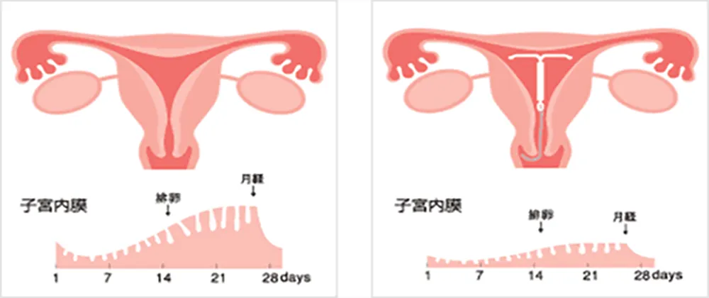 子宮内膜の変化