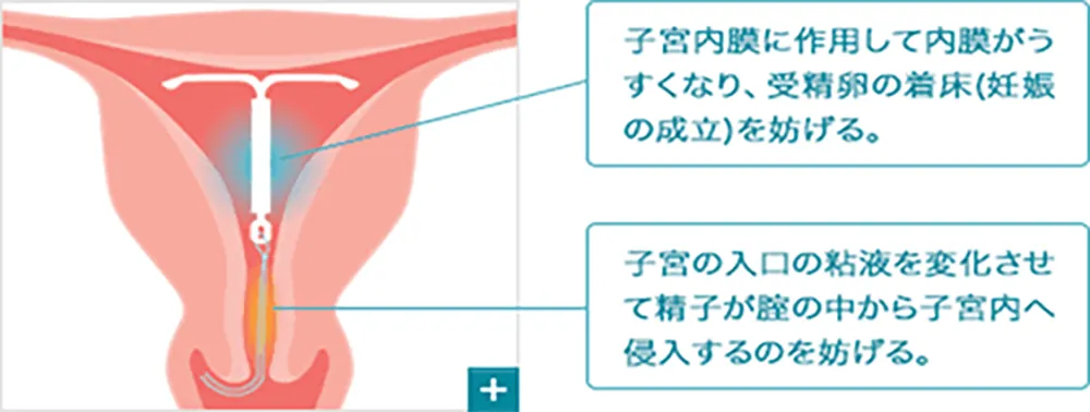 子宮内に装着されたミレーナ52mg