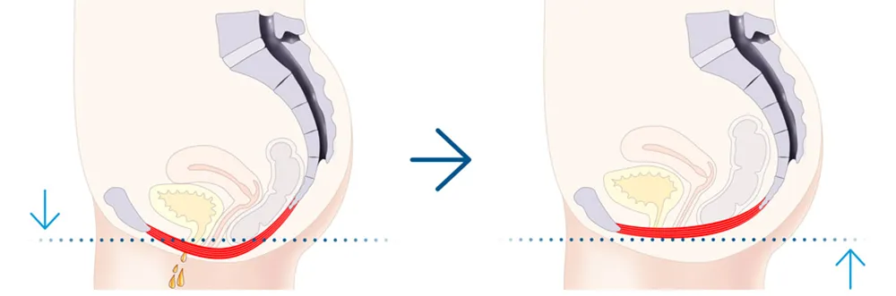 骨盤底筋の筋力アップの前後図