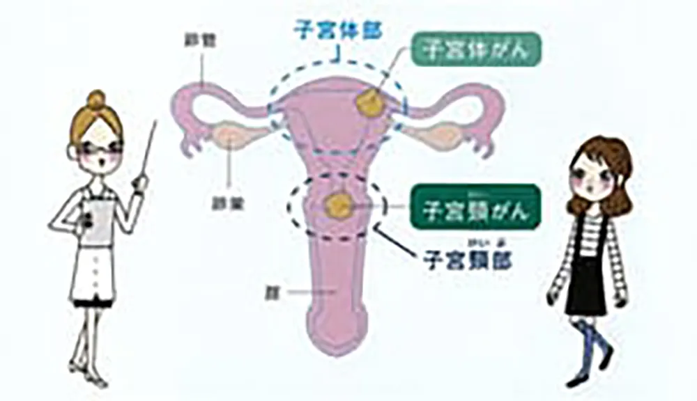 子宮がん