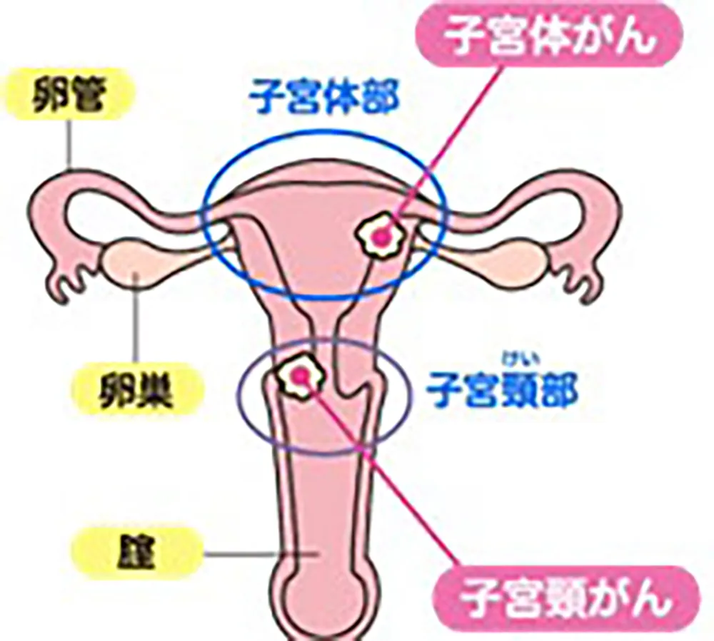 子宮頸がんと子宮体がんについて